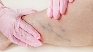 Vein Correction